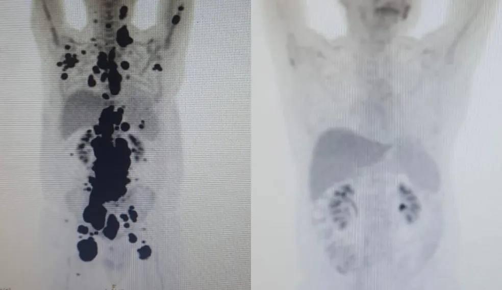 Antes e depois de petscan de paciente com linfoma taratado com CAR-T Cell