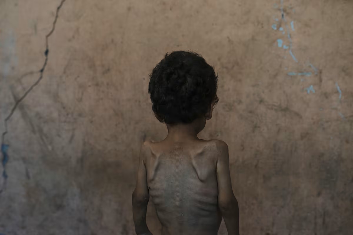 ONU reconhece oficialmente fome em Gaza e acusa Israel de obstruir ajuda
