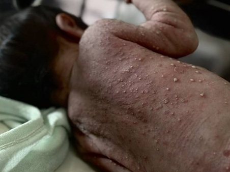 Catapora avança em acampamentos superlotados e agrava crise sanitária em Gaza